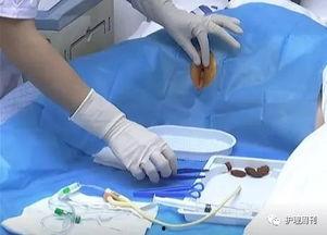 男性导尿管视频,男性导尿管使用操作视频详解